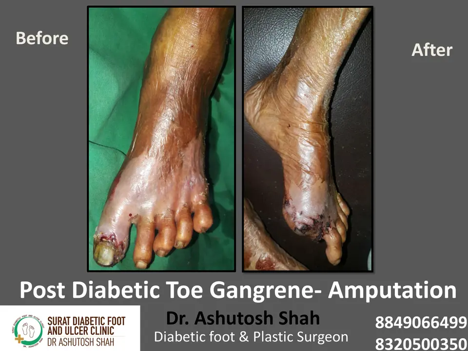 Diabetic Foot  PPT 3 checked by sir.pptx-51.webp